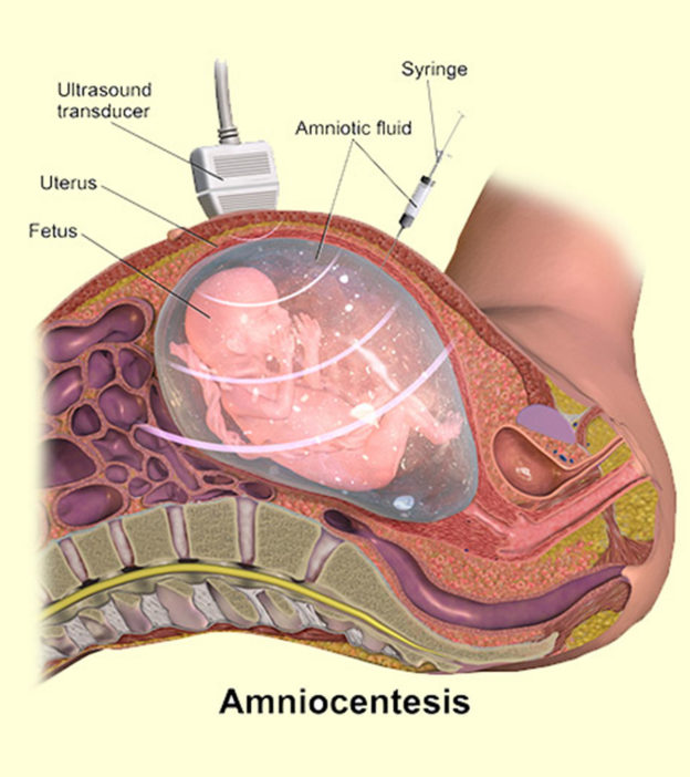 एम्नियोसेंटेसिसटेस्‍ट:प्रक्रिया,परिणामवलागत|羊膜穿刺术在印地语测试